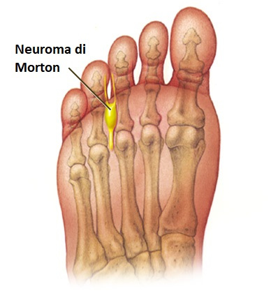 Neuroma di morton nevralgia metatarsalgia dolore dita dei piedi