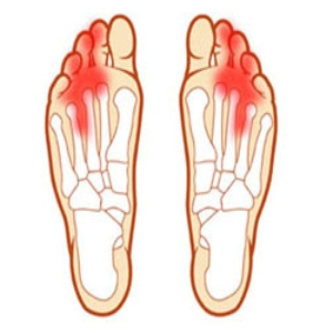 Sintomi neuroma di morton dolore dita piedi metatarsalgia