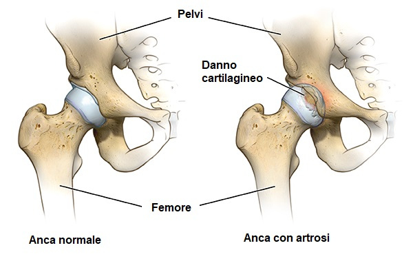 artrosi anca dolore complicanze morbo di perthes