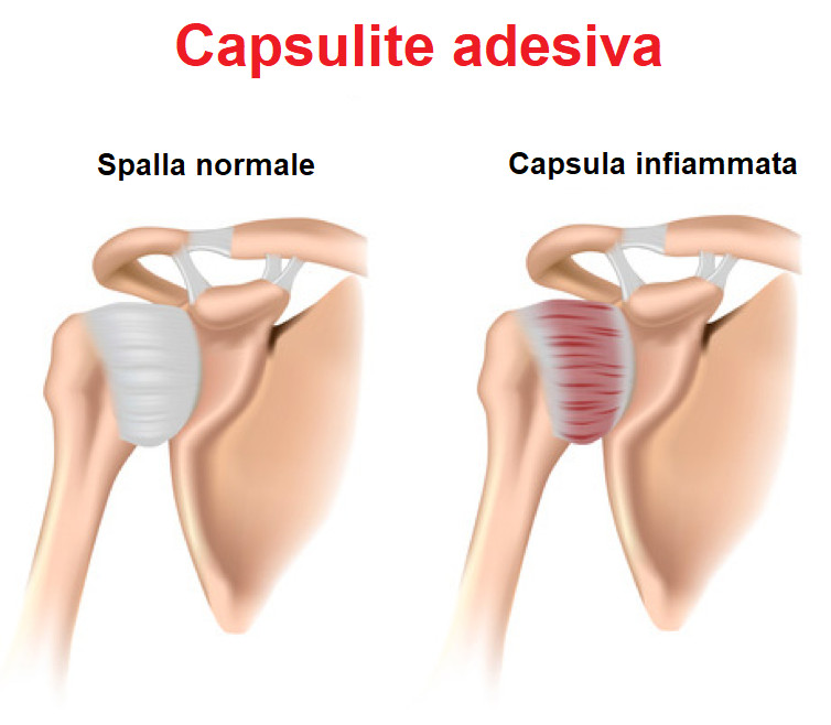 capsula spalla infiammata capsulite adesiva