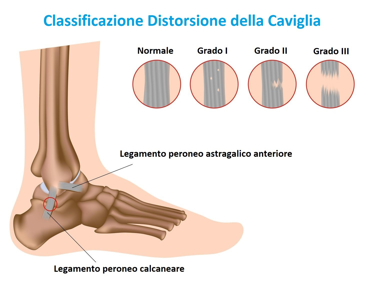 classificazione distorsione della caviglia