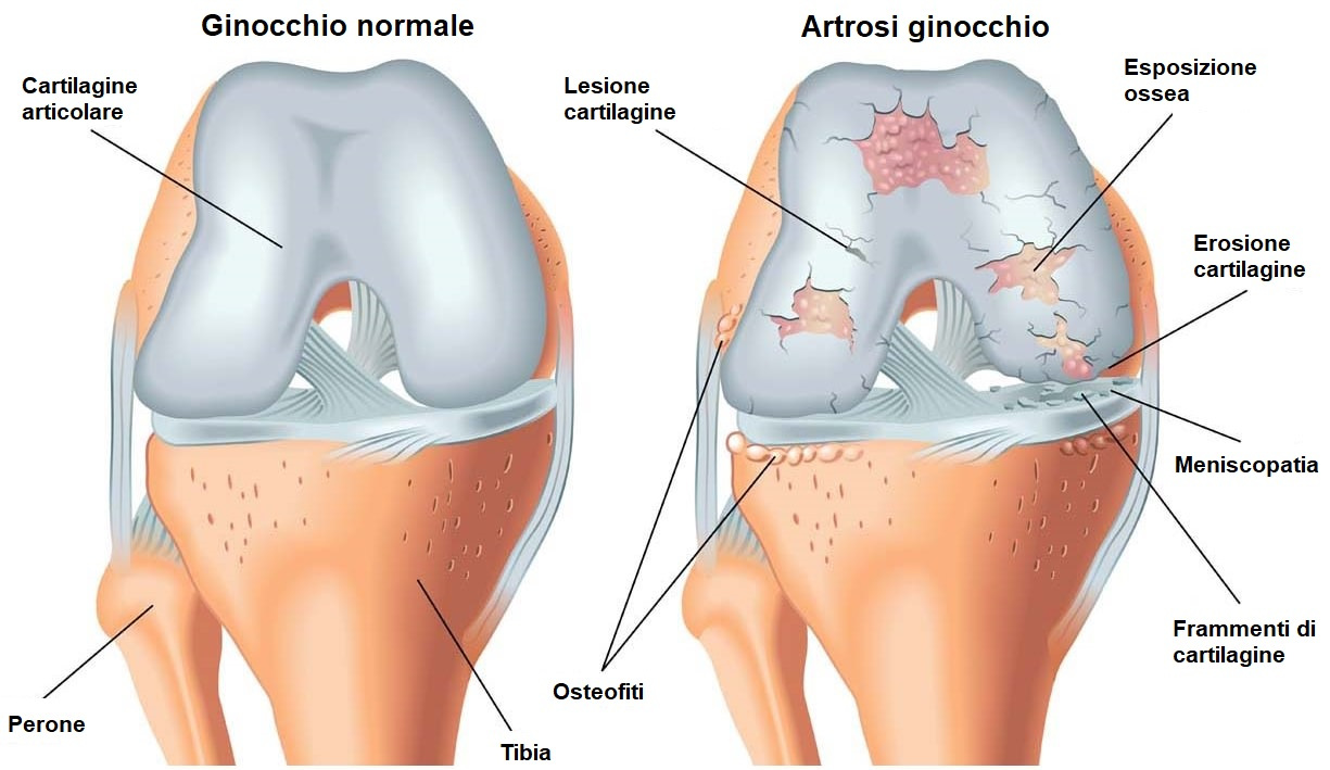 degenerazione lesione cartilagine osteofiti osteoartrosi ginocchio