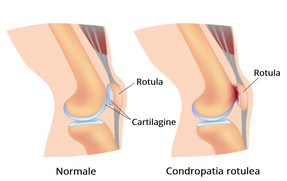degenerazione lesione cartilagine rotula