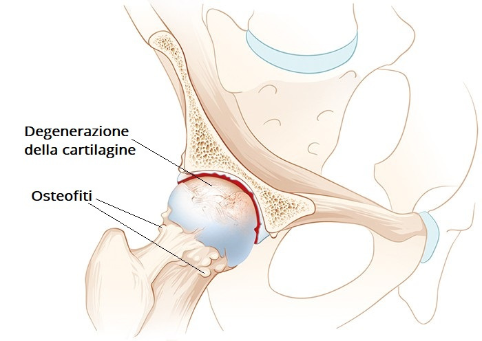 degenerazione usura cartilagine coxartrosi
