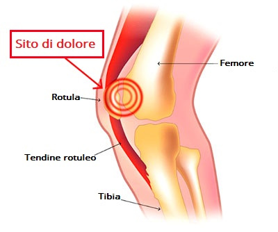 dolore anteriore ginocchio rotula
