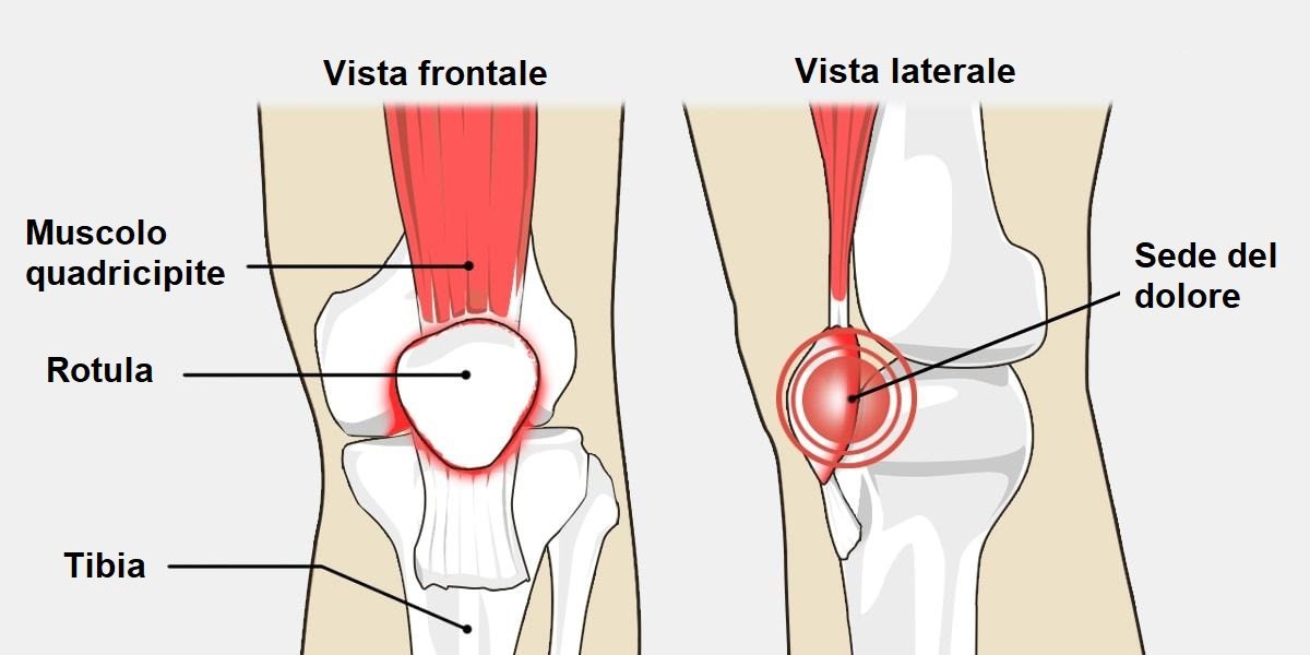 dolore anteriore ginocchio sindrome femoro rotulea