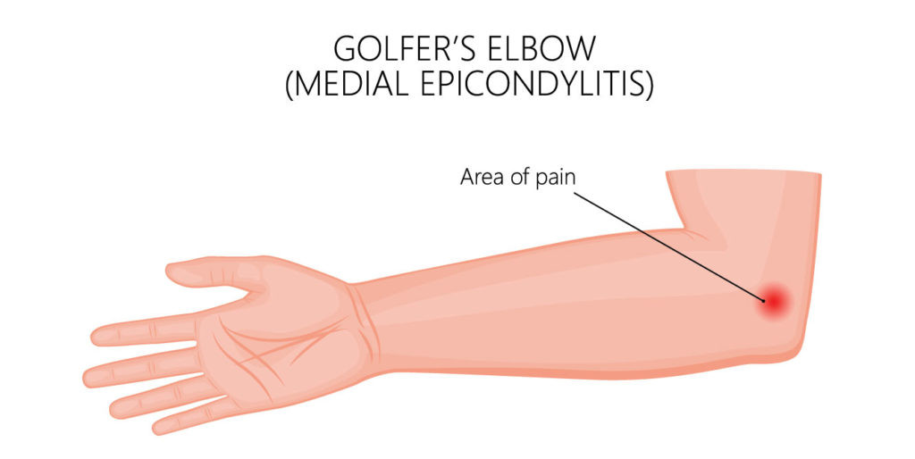 dolore gomito sintomi epitrocleite gomito dedl golfista