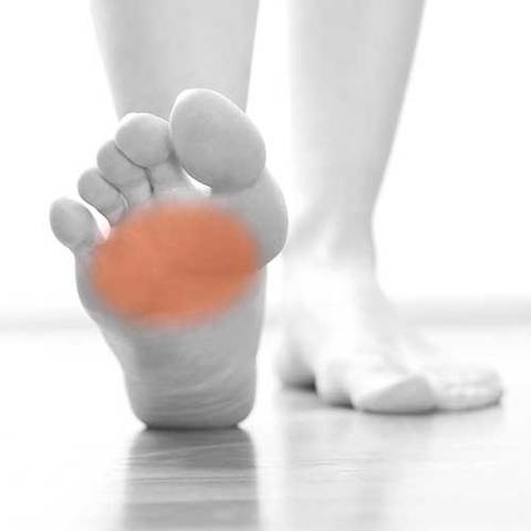 neuroma di morton dolore dita piedi metatarsalgia