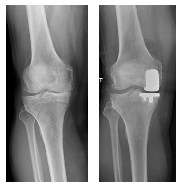 protesi monocompartimentale parziale ginocchio