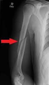radiografia rx frattura diafisi omero