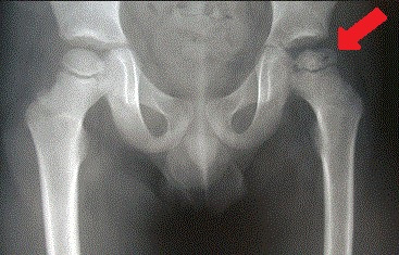 radiografia rx malattia legg calvé perths anca