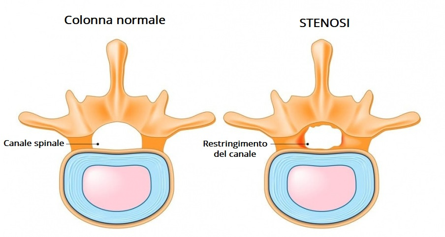 restringimento canale vertebrale stenosi lombare