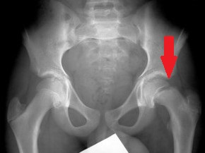 rx epifisiolisi testa del femore scivolamento dolore anca