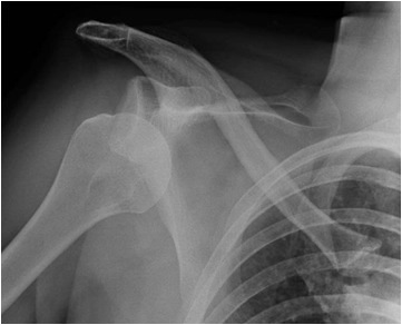 rx radiografia imaging lussazione spalla dislocazione