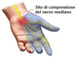 sito compressione nervo mediano tunnel carpale