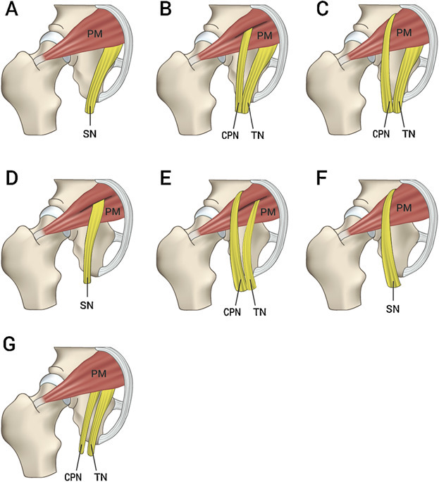 varianti anatomia nervo sciatico sindrome del piriforme